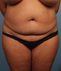 Abdominoplasty
