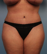 Abdominoplasty
