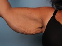 Brachioplasty