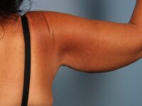 Brachioplasty