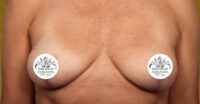 Breast Implant Removal and Lift