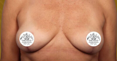 Breast Implant Removal and Lift Case 35362 After Photo Breast Implant Removal and Lift