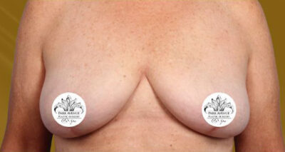 Breast Implant Removal and Lift Case 35363 After Photo Breast Implant Removal and Lift