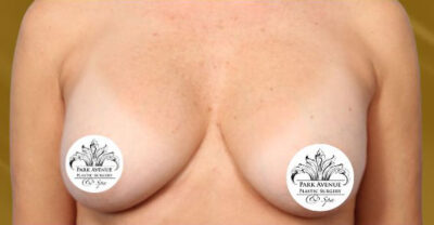 Breast Implant Removal and Lift Case 35362 Before Photo Breast Implant Removal and Lift