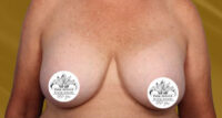 Breast Implant Removal and Lift