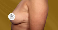 Breast Implant Removal and Lift