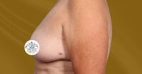 Breast Implant Removal and Lift