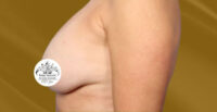 Breast Implant Removal and Lift