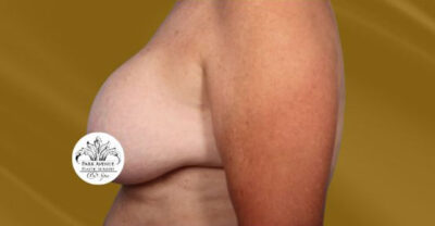 Breast Implant Removal and Lift Case 35363 Before Photo Breast Implant Removal and Lift