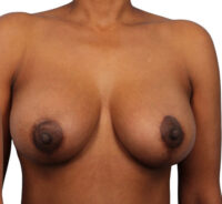 Breast Augmentation with Lift