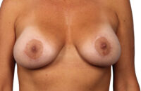 Breast Revision