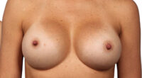 Breast Revision