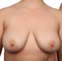 Breast Reduction