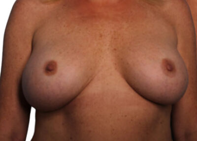 Breast Revision