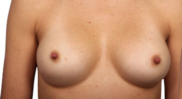 Breast Revision
