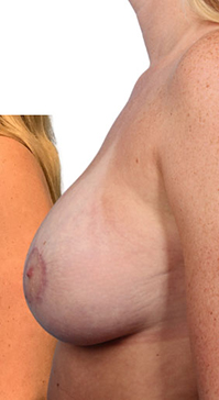 Breast Augmentation with Lift