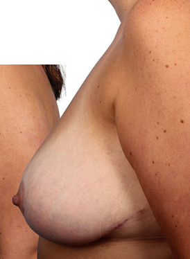 Breast Reduction
