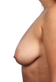 Breast Augmentation with Lift