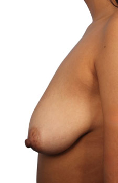 Breast Augmentation with Lift