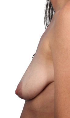 Breast Augmentation with Lift