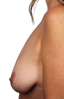 Breast Augmentation with Lift