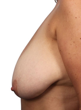 Breast Reduction