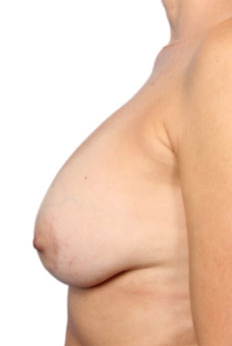 Breast Implant Removal and Lift