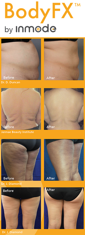 BodyFX Orlando  Non Surgical Fat Removal Florida