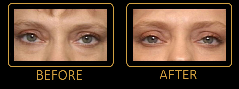 Blepharoplasty Before and After Photos