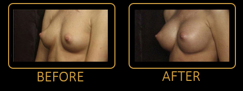 Breast Augmentation Results Orlando