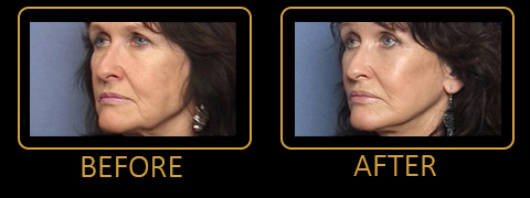 Facelift Before and After Photos