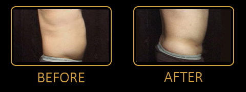 High-Definition Liposuction in Orlando, FL - Plastic Surgery in