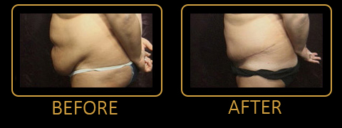 Abdominoplasty Before and After Photos