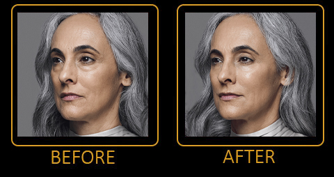 Revance Filler Before and After Photos